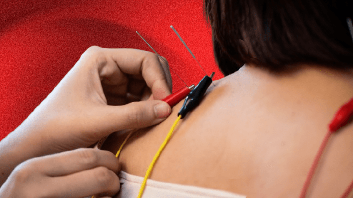 Electroacupuncture Is Acupuncture's Livelier Cousin – But Does It Work? 7